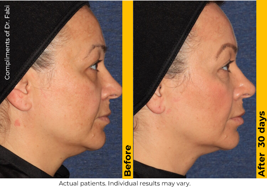 Ultherapy before and after 30 days, side profile of a female patient